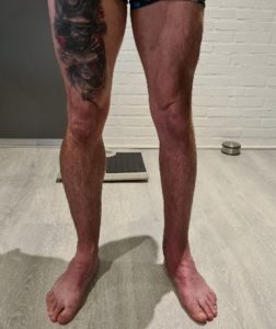 Spieratrofie bij gebroken been